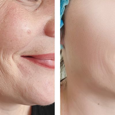 Close-up before and after skin texture comparison — customer submitted, results vary